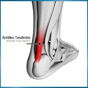 גיד אכילס – Achilles tendon