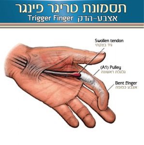 תסמונת אצבע-ההדק – Triger finer syndrome