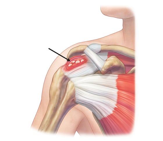 Calcific Tendonitis of shoulder, הסתיידות בכתף כתוצאה משקיעה של סידן ברקמות הרכות בכתף כמו הגידים